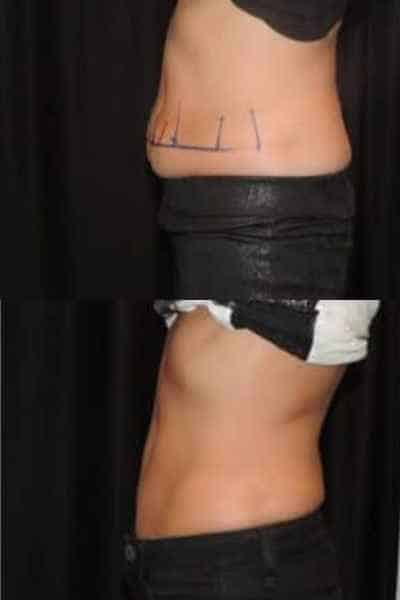 HIEMT Muscle Toning Berkshire