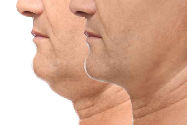 HIFU - Breakthrough in Anti - ageing 2 hifu results Berkshire