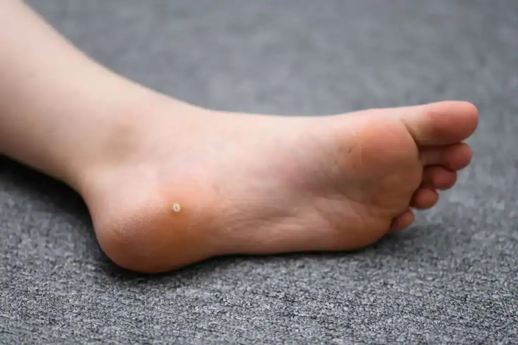 Cryotherapy For Warts And Also Verrucas 2 Image of verruca on the bottom of the foot that able to be treated with Cryotherapy Berkshire
