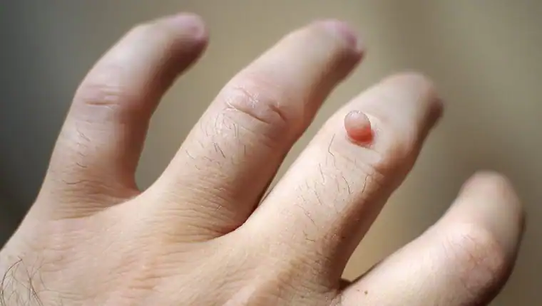Image of blemish that Cryotherapy Berkshire can remove with Lipo 360.