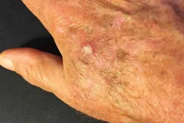 Image of Actinic keratoses Berkshire on a person hand