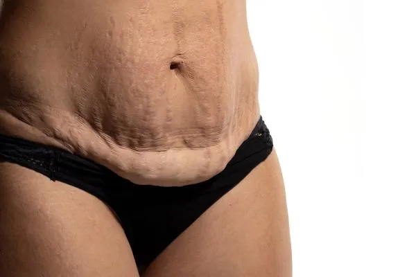 The science behind skin tightening Berkshire picture of a woman's sagging skin on the stomach